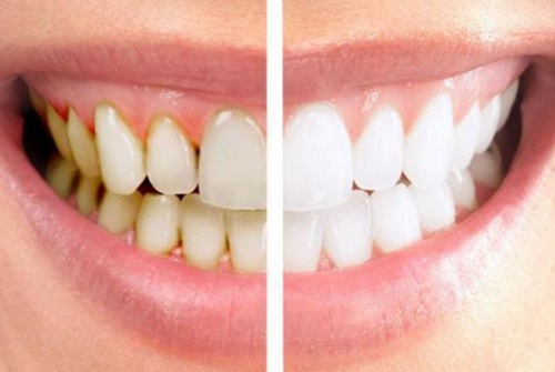 牙齿美容冠的价格构成及影响因素