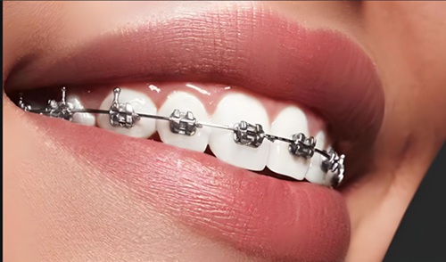 青少年牙齿矫正的危害与预防措施