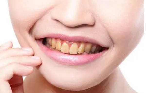 瓷贴面修复牙缝解决方案是什么?
