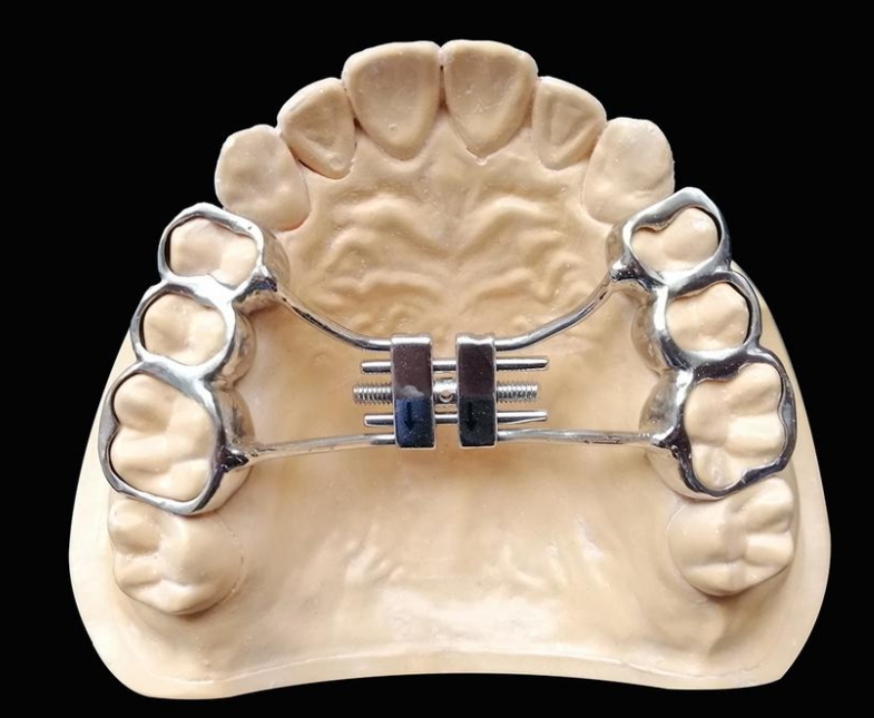 金属牙齿矫正器的工作原理