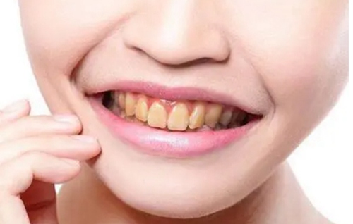 探秘牙齿变色的真相：原因、有效治疗与日常预防
