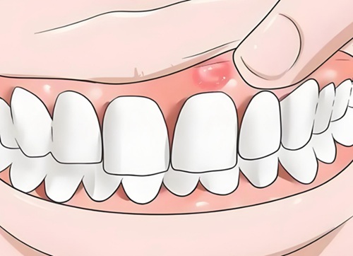 如何处理并避免牙龈肿痛反复发生