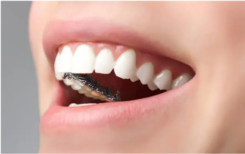 牙齿稀疏可以矫正吗?