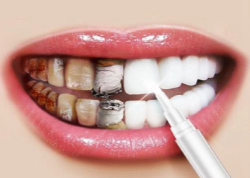 预防龋齿的有效方法是什么?