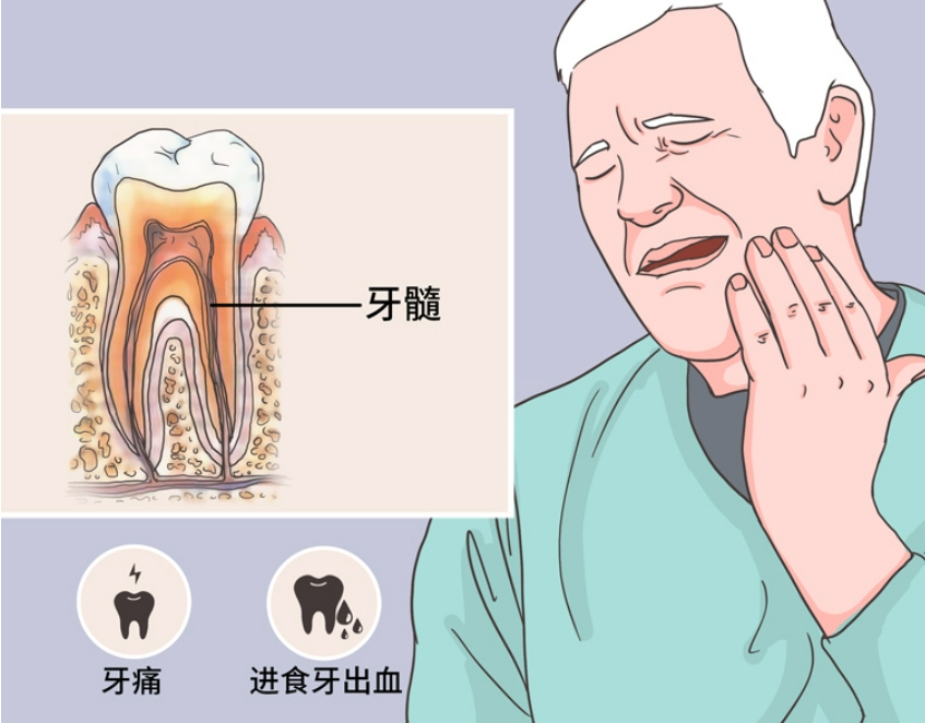 什么是牙髓炎,它和蛀牙有什么区别？