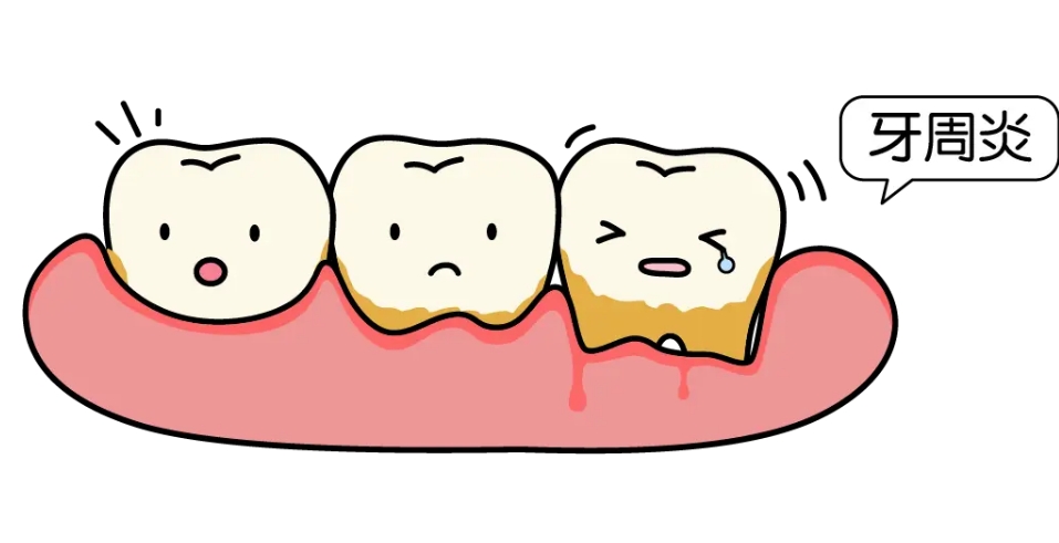 牙周炎是怎么回事？治疗费用是多少？
