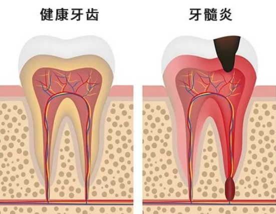 为什么得了牙髓炎会疼得睡不着觉？