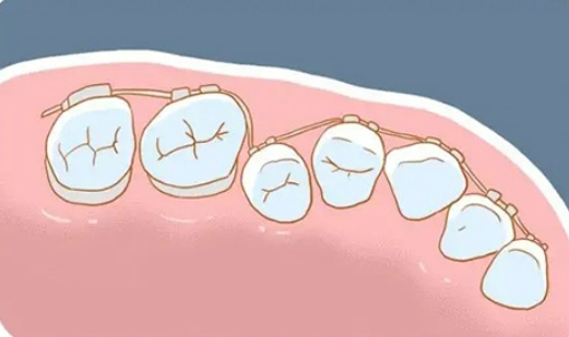 矫正牙齿年龄大了哪种方法更适合