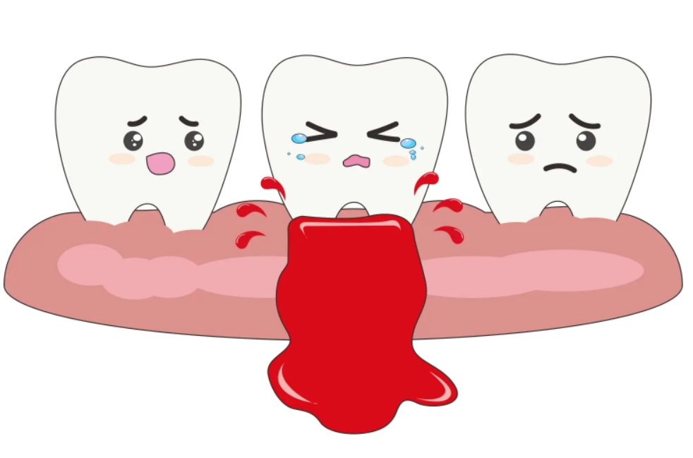 牙龈出血的治疗方法是什么？