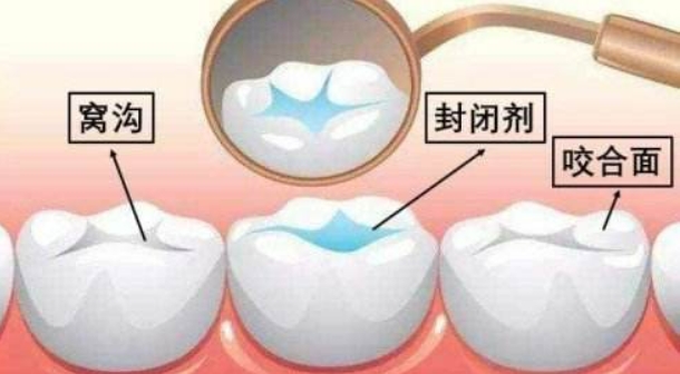 儿童窝沟封闭需要多久做一次比较好?