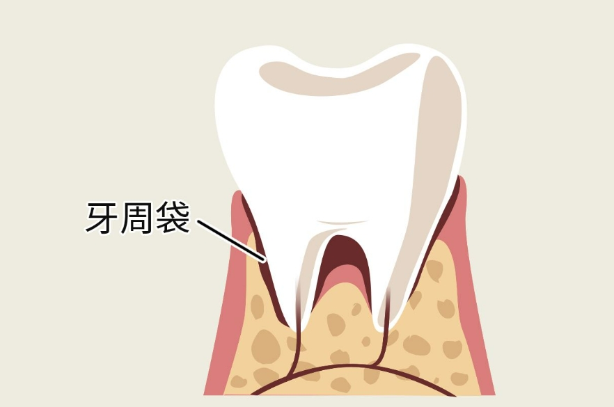 牙周袋会自己消失吗？如何治疗牙周袋？