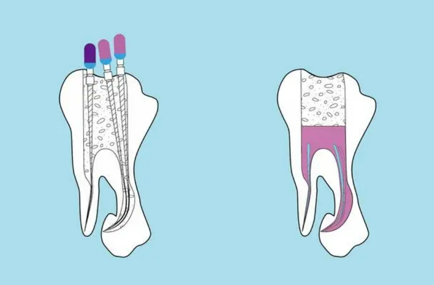 根管治疗后还会牙疼吗？