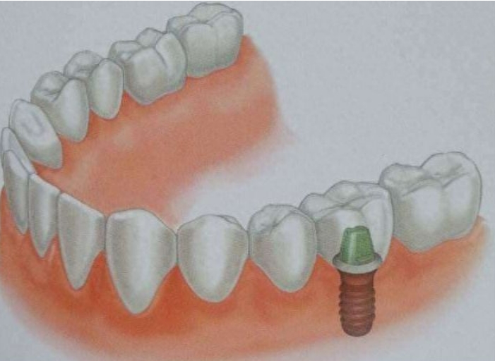 成年人种植牙的整个过程全面介绍