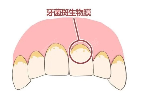 洗牙有什么好处?洗牙是会让牙齿越变越松?