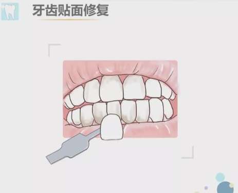 牙齿贴面和牙冠哪个好？各自优缺点是什么？