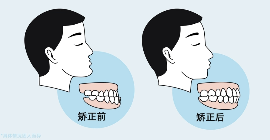 为什么有些人牙齿矫正需要拔牙，而有些人不需要呢？